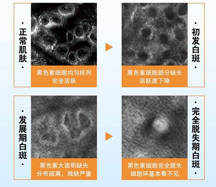 白癜风治疗后复发怎么办